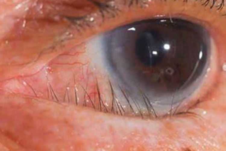瘢痕性睑内翻症状图 瘢痕性睑内翻症状图