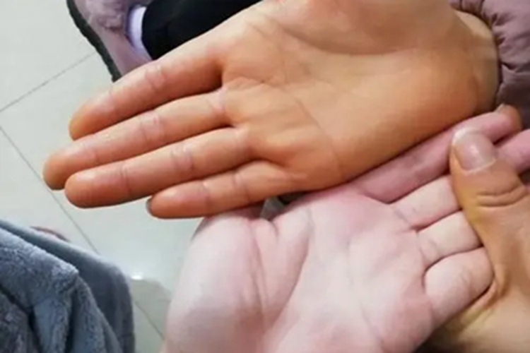 胡萝卜素血症手掌变黄图