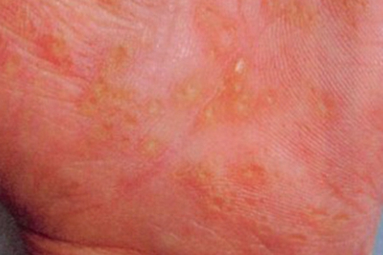 遗传性掌跖角化病手掌丘疹图 遗传性掌跖角化病手掌丘疹图