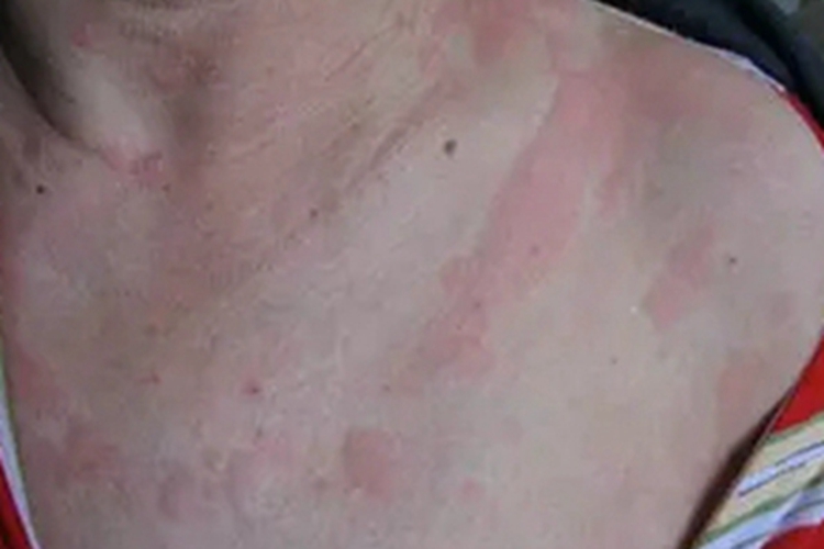 延迟性压力性荨麻疹胸部发红图