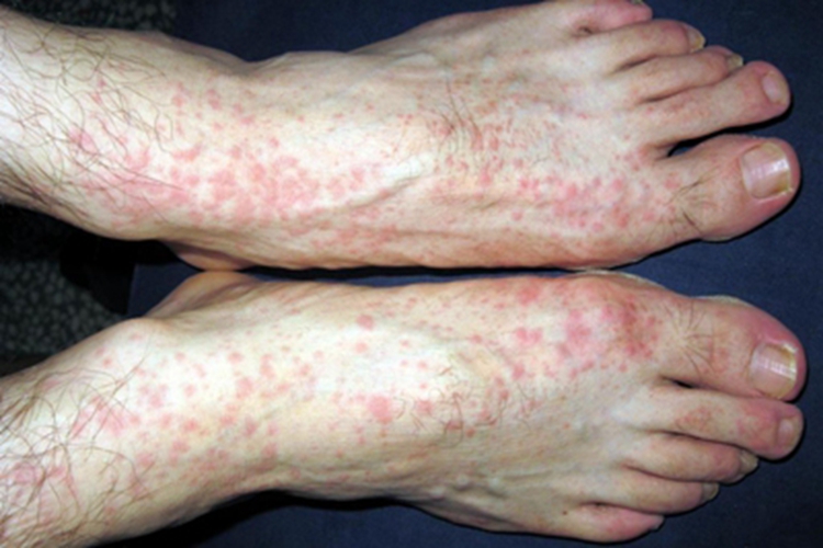 湿疹型药疹丘疹图 湿疹型药疹丘疹图