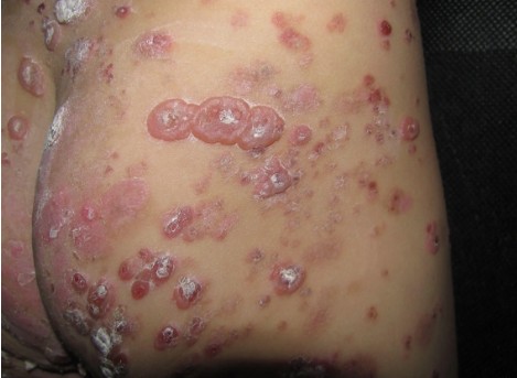 淋球菌感染女性症状图片