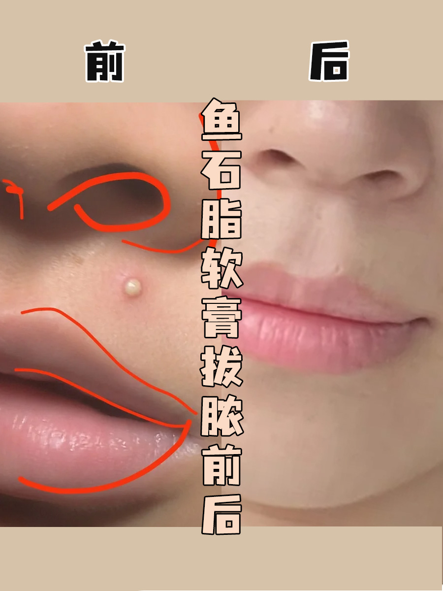 姐妹们看过来！鱼石脂软膏拔脓过程全记录！