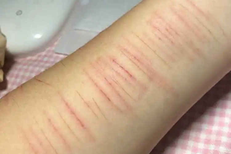 人工皮炎胳膊条纹图