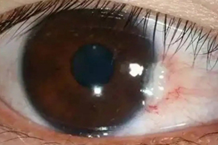 静止期翼状胬肉症状图