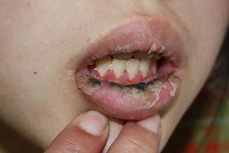 急性光化性唇炎嘴唇症状图