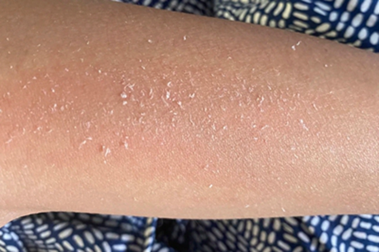 日照性皮炎胳膊脱屑图