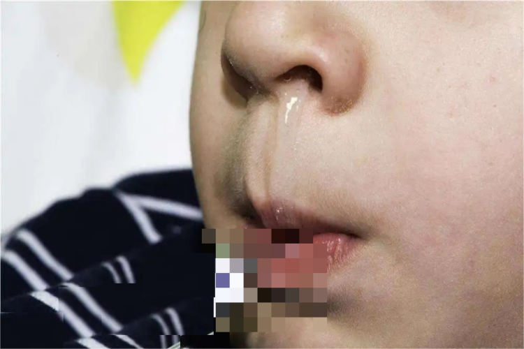 清水鼻涕图