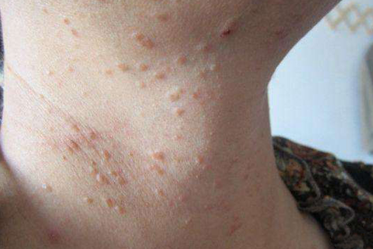 脖子扁平疣图 脖子扁平疣图