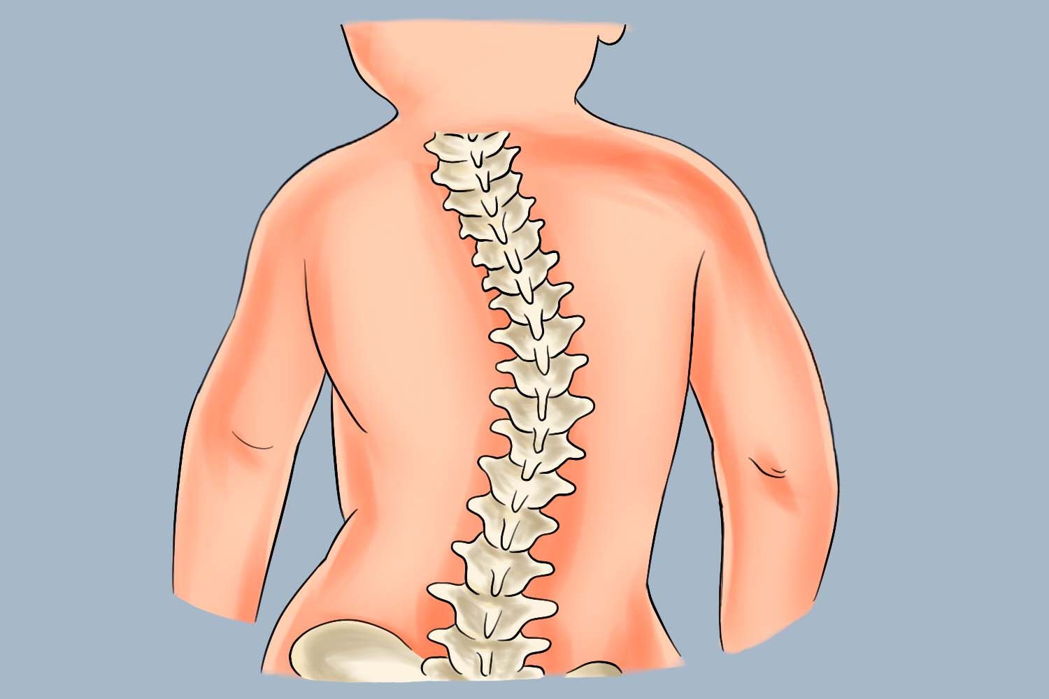 宝宝脊柱侧弯图