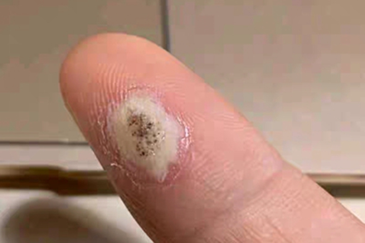 寻常疣手指尖有豆大的硬块图