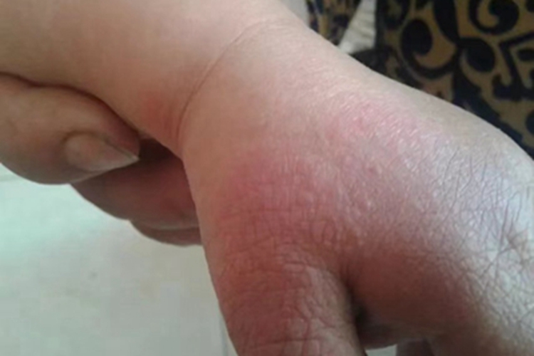 急性湿疹手背发红起小疙瘩图 急性湿疹手背发红起小疙瘩图