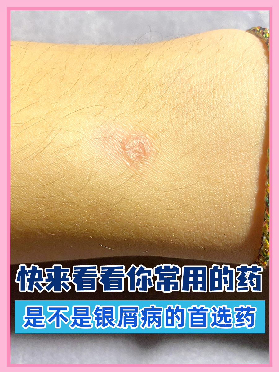 寻常型银屑病首选药 | 皮肤科医生干货总结