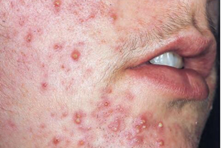 毛囊性脓疱病脓包图