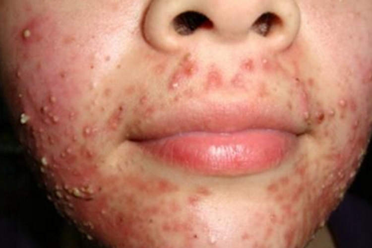 寻常痤疮面部脓包图