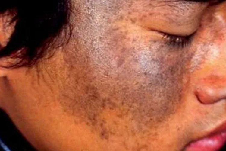 瑞尔黑变病面部症状图