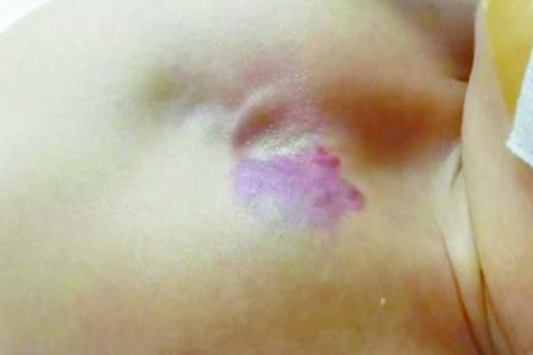 小孩胸骨上裂图