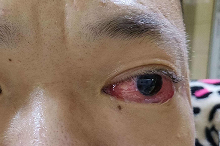 眼眶肿瘤眼球红肿图