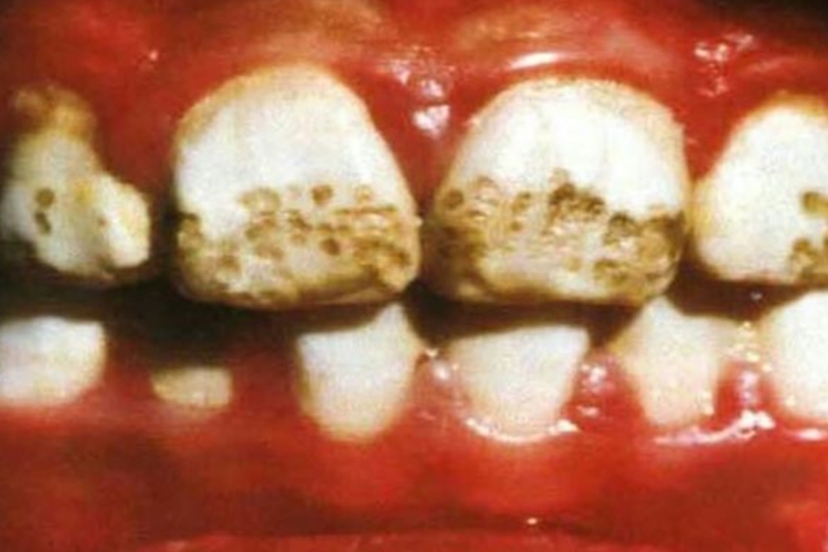 重度氟斑牙图