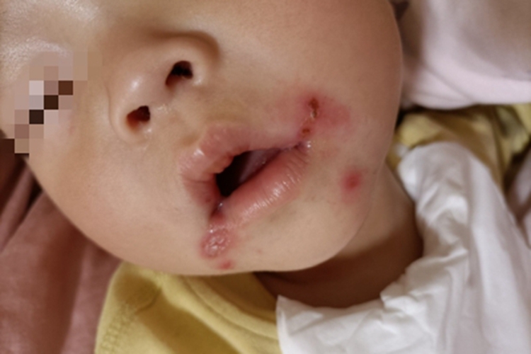 口腔单纯性疱疹症状图