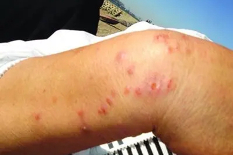 早期性病性淋巴肉芽肿症状图