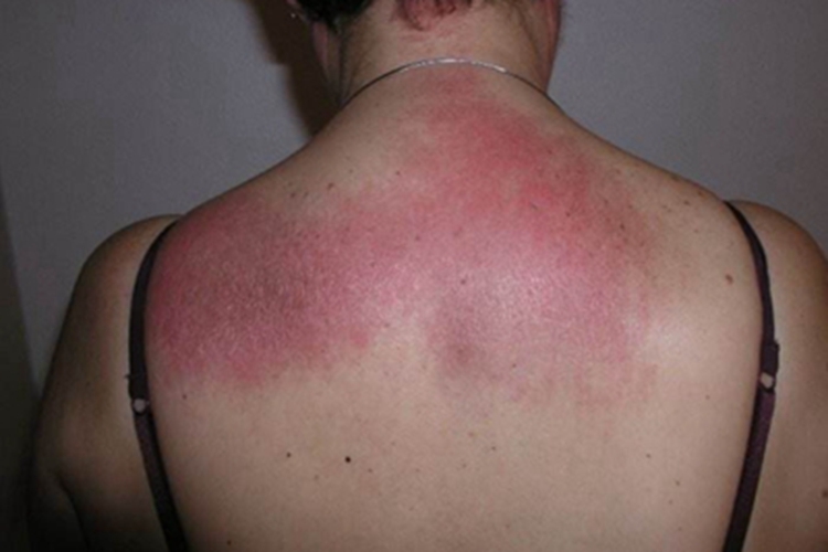 寻常狼疮背部发红图