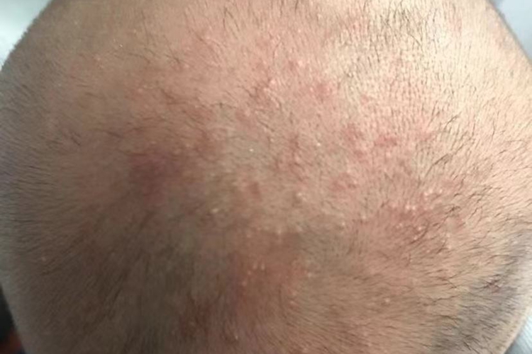 婴儿头皮热疹图