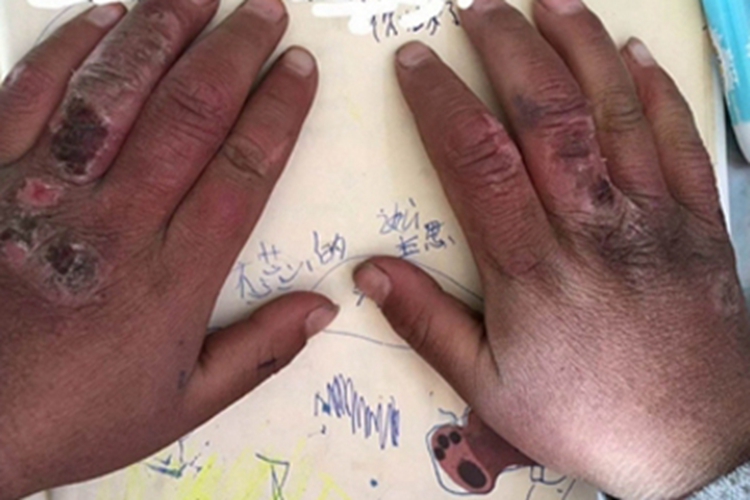 冻疮双手明显粗糙结痂图