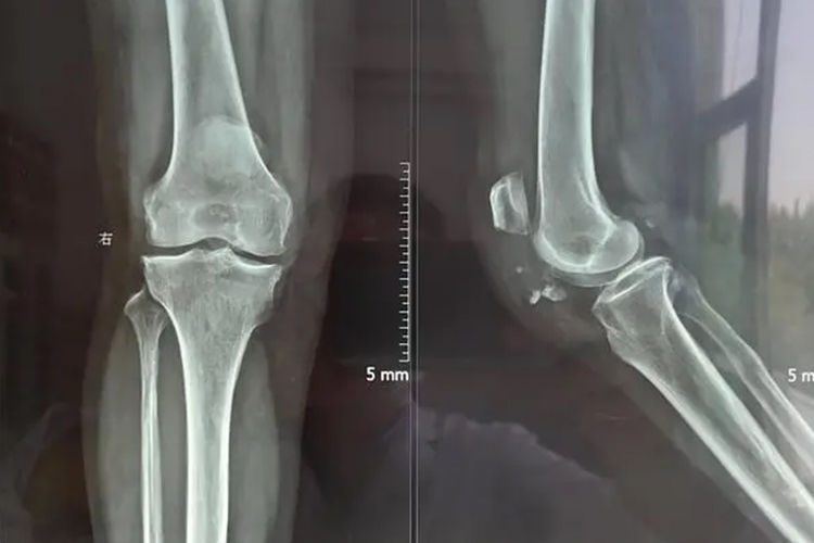 膝盖脱位X线图