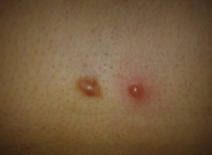 瘢痕疙瘩初期红色丘疹图