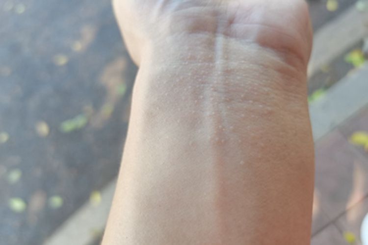 光泽苔藓手腕丘疹图 光泽苔藓手腕丘疹图