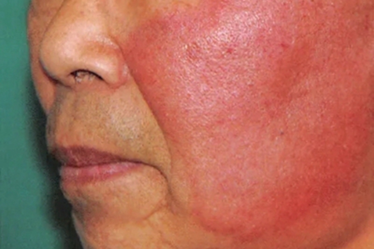 急性淋巴管炎面部红肿图