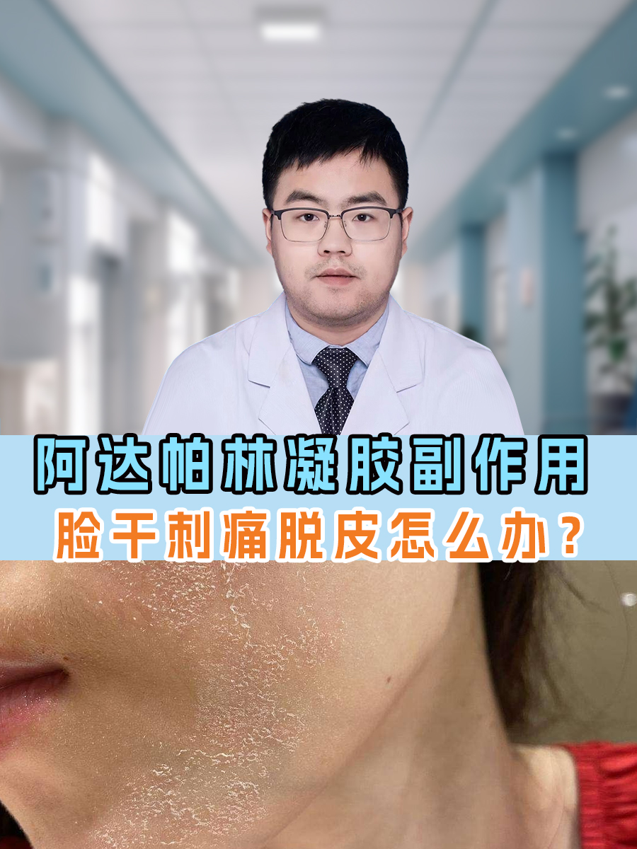 阿达帕林凝胶副作用:脸干刺痛脱皮怎么办?