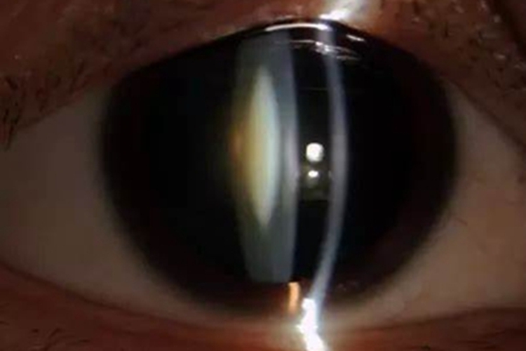 后囊下白内障症状图