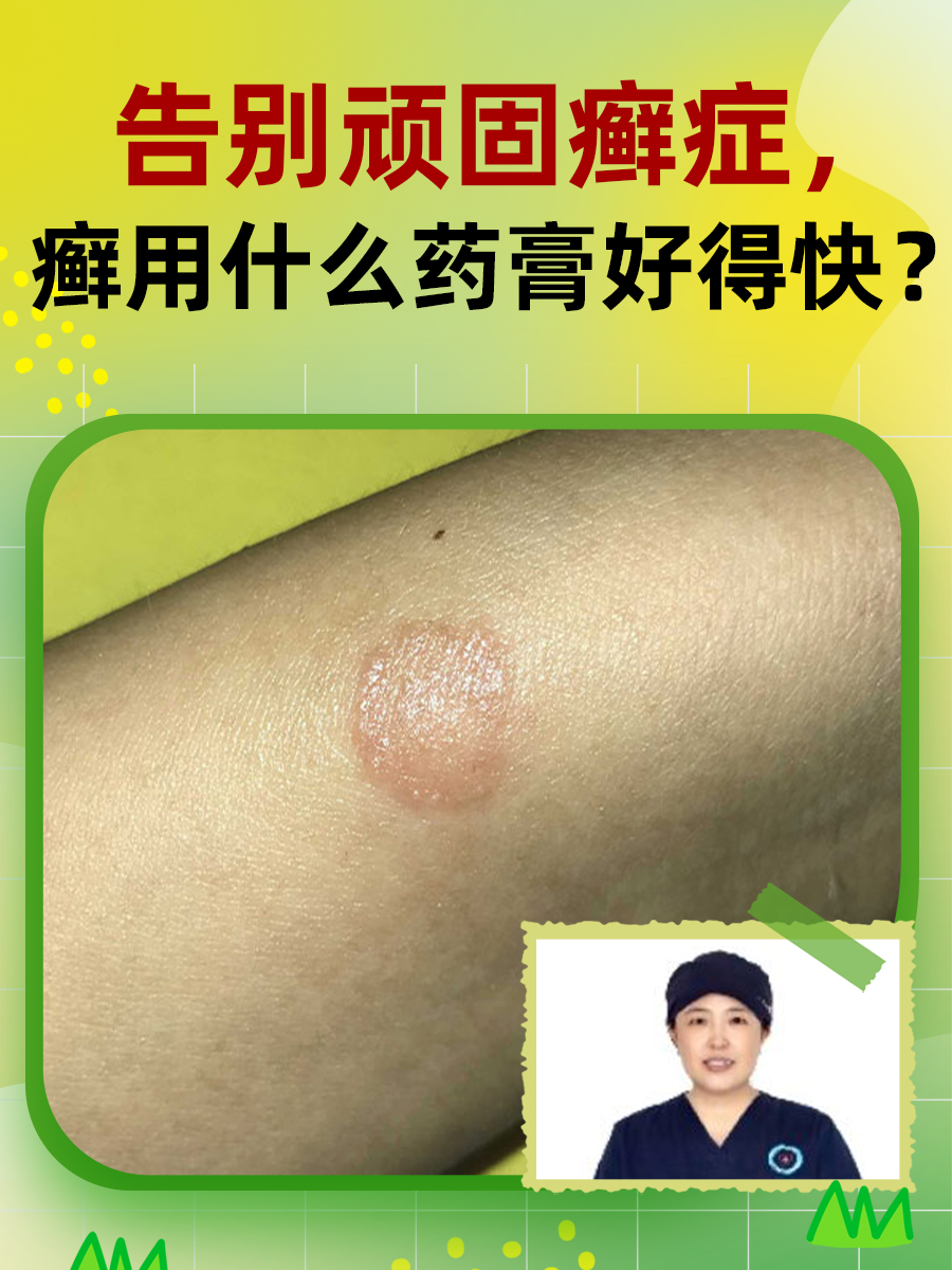 告别顽固癣症，癣用什么药膏好得快？