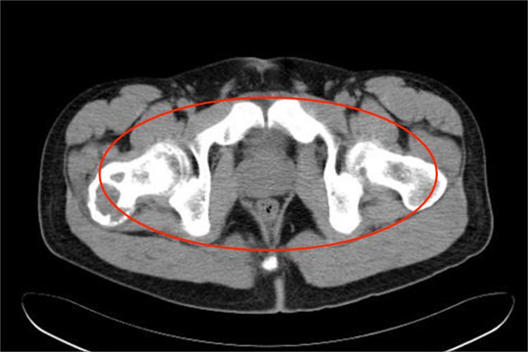 耻骨动脉瘤样骨囊肿影像图