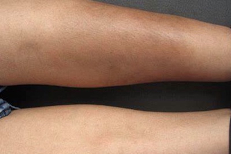 硬化性脂膜炎小腿症状图 硬化性脂膜炎小腿症状图