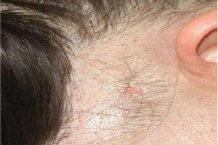 拔毛癖头发脱发图