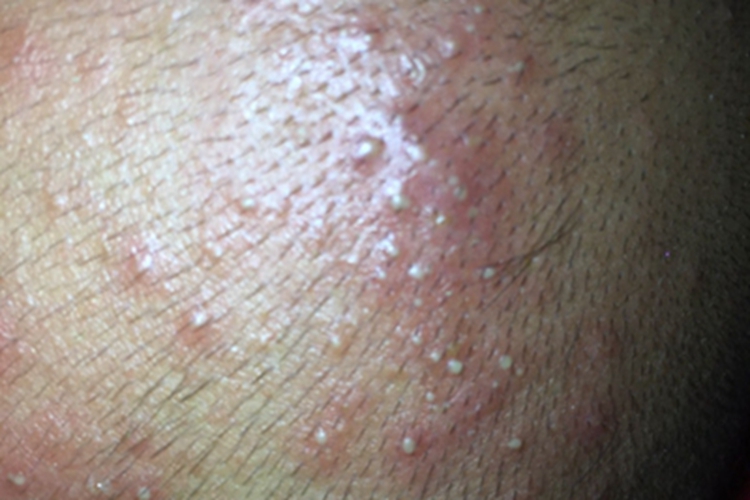 脓痱症状图 脓痱症状图