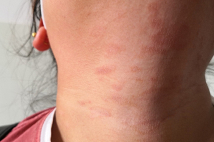 玫瑰糠疹前颈红斑图 玫瑰糠疹前颈红斑图