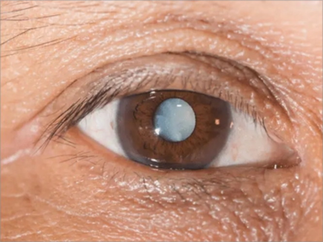 皮质性白内障眼球斑图