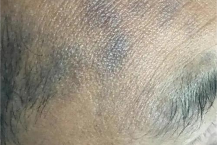 焦油性黑变病额头发黑图 焦油性黑变病额头发黑图