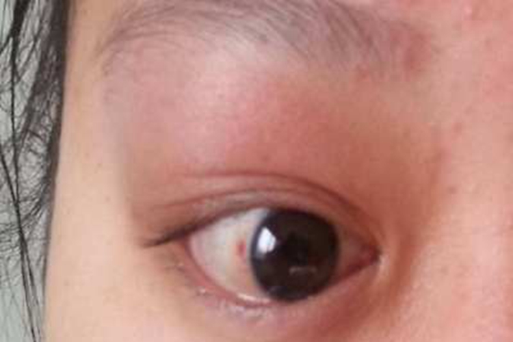 眼眶皮样囊肿眼睑症状图 眼眶皮样囊肿眼睑症状图