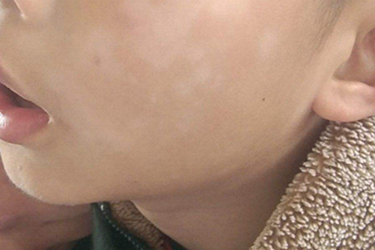 虫斑脸上有圆形白斑图