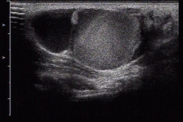 蔓状血管瘤超声图 蔓状血管瘤超声图