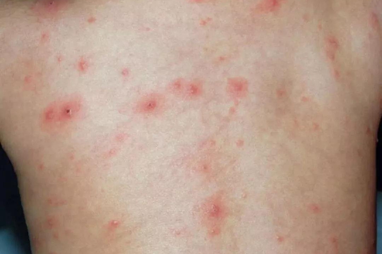 急性排异身上皮疹图 急性排异身上皮疹图