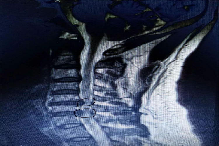 颈椎567突出图 颈椎567突出图