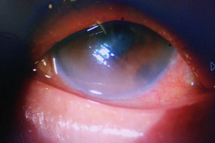 角膜挫伤角膜水肿图 角膜挫伤角膜水肿图