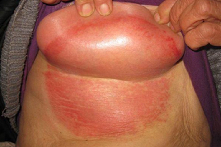 念珠菌性间擦疹乳房红斑图