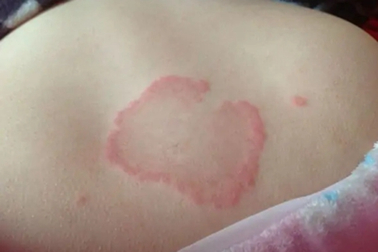 单纯性回状红斑背部红斑图